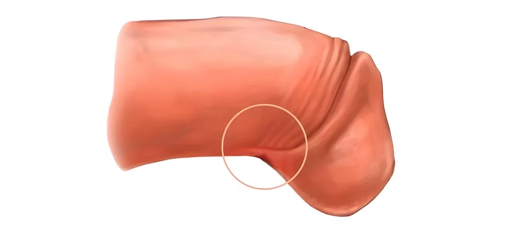 Frenuloplastia láser